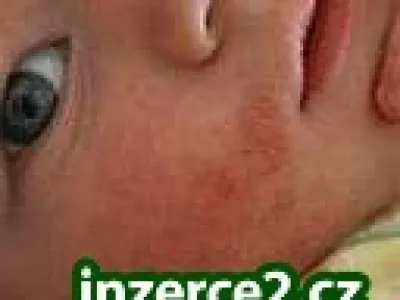 EKZÉMY, LUPÉNKA, BRADAVICE, JIZVY..