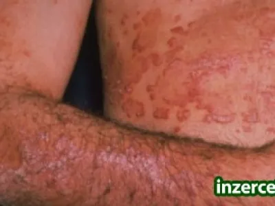 Trápí Vás lupénka?:o(Zkuste Omegu a Ok balzám