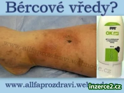 Bércové vředy