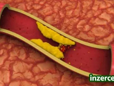Strašák jménem CHOLESTEROL