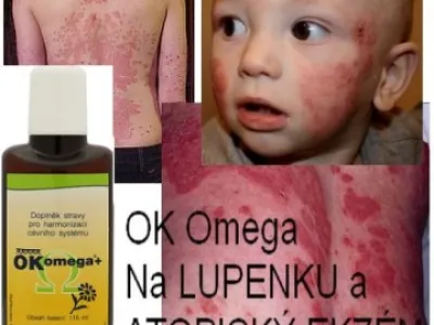 ATOPICKÝ ekzém a LUPENKA