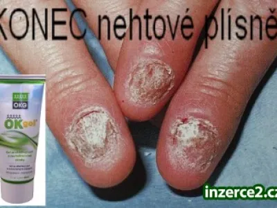 Nevíte jak na NEHTOVOU PLÍSEŇ? možnost 40% slevy