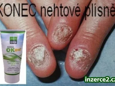 Nevíte jak na NEHTOVOU PLÍSEŇ?