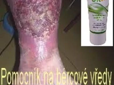 Nevíte jak na BÉRCOVÉ VŘEDY?