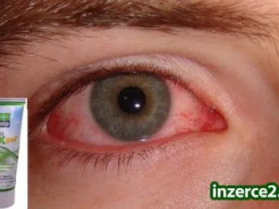 ZÁNĚT SPOJIVEK, ZÁNĚT UŠÍ